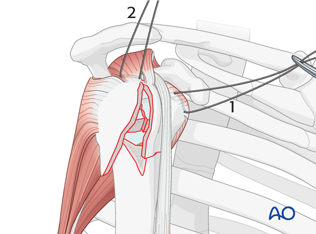 Begin by inserting sutures into the insertion fibers of subscapularis tendon (1) and the supraspinatus tendon (2)