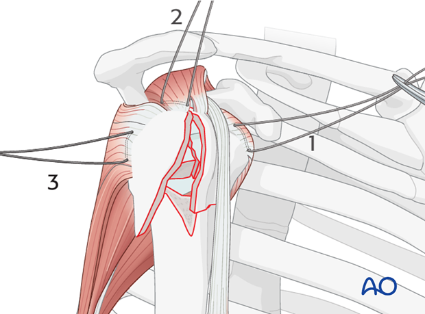 Next, place a suture into the infraspinatus tendon insertion (3)