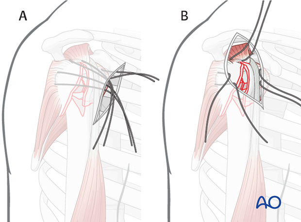 It is easier the further lateral of an approach is used. A) shows an deltopectoral approach and B) an anterolateral approach