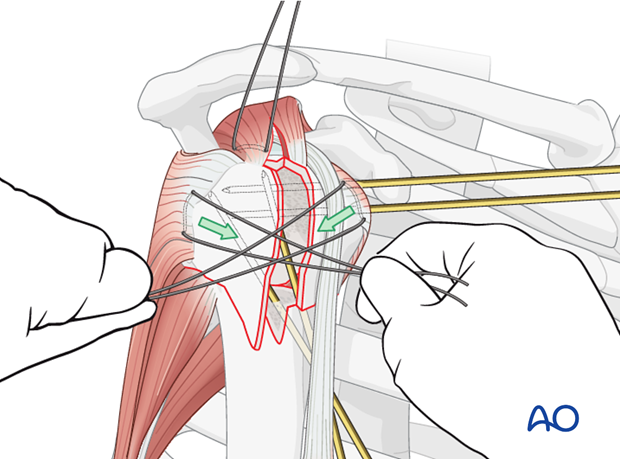 Pull the sutures between the subscapularis and the infraspinatus tendons horizontally ...
