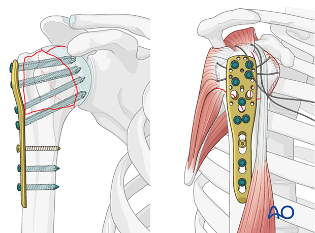 Insert one or two additional bicortical screws into the humeral shaft. 