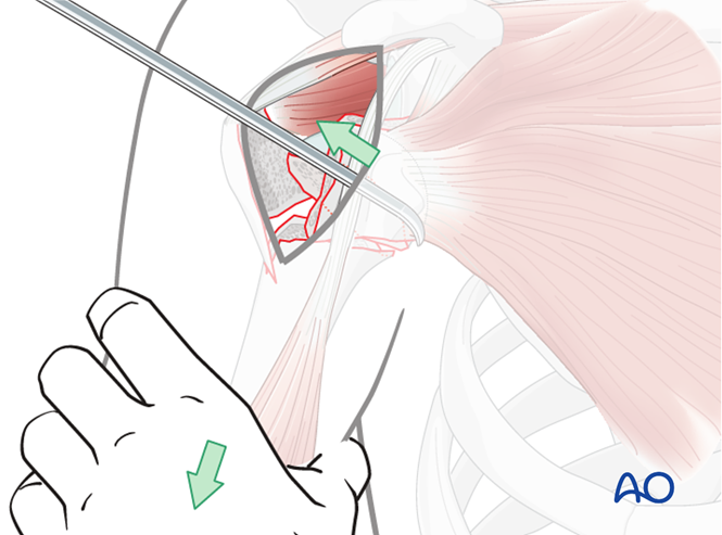 ORIF - Plate fixation for 4-Part, dislocation, simple metaphyseal ...