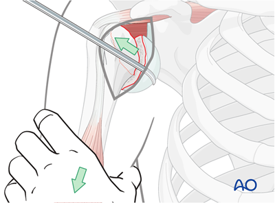 ORIF - Plate or screw fixation for Isolated anatomical neck, dislocation