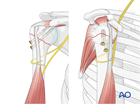 extraarticular 2 part surgical neck impaction