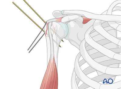 ORIF - Screw or suture fixation for Extraarticular 2-part, greater ...