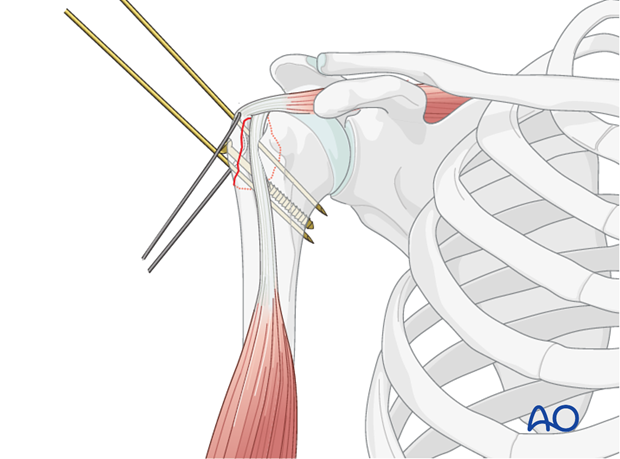 11_O40_i250 Lag screw insertion