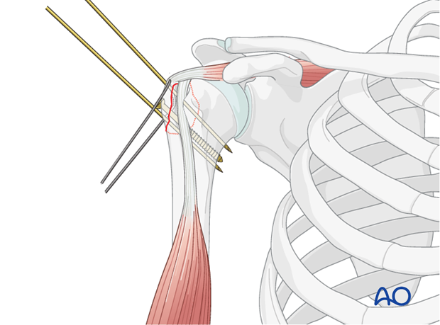 Lag screw insertion