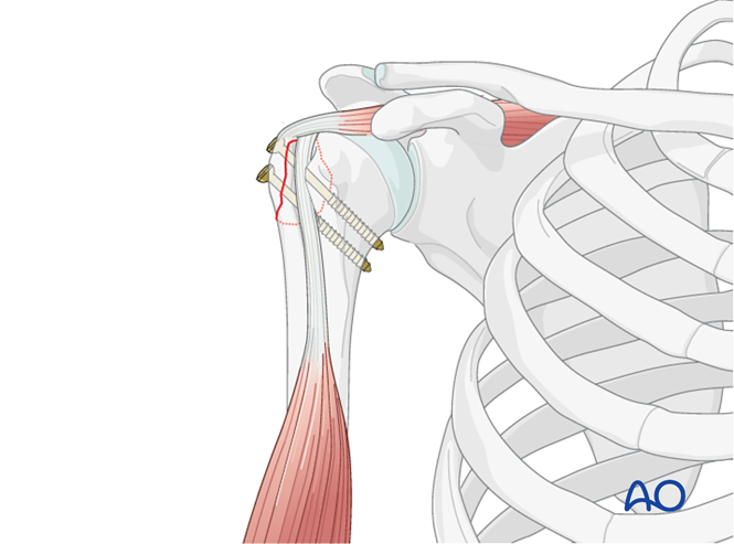 ORIF - Screw or suture fixation for Extraarticular 2-part, greater ...