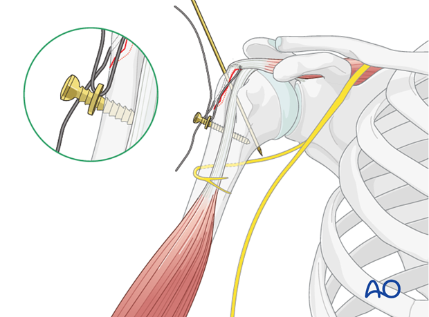 Suture passed through a washer