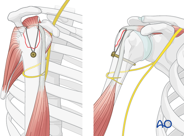 Suture tightened and tied