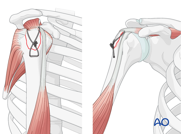 11_O40_i300 Suture passed in figure-of-eight