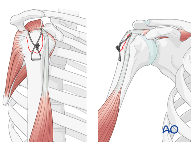 Suture passed in figure-of-eight