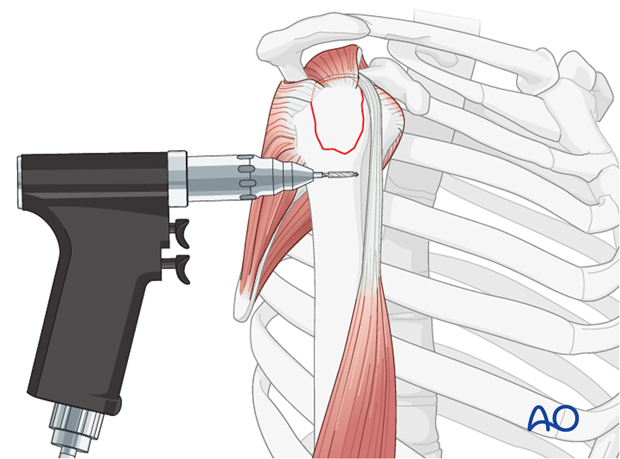 Hole drilled into humerus