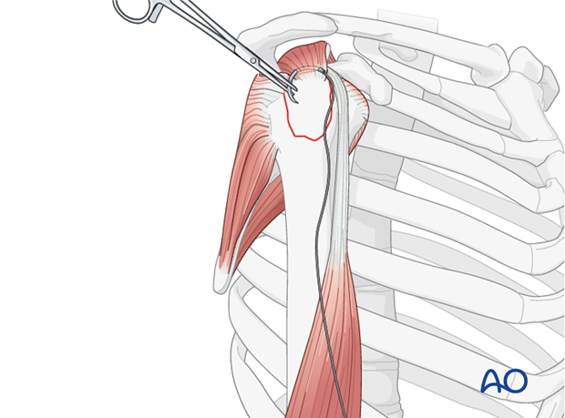 Suture insertion into rotator cuff tendon