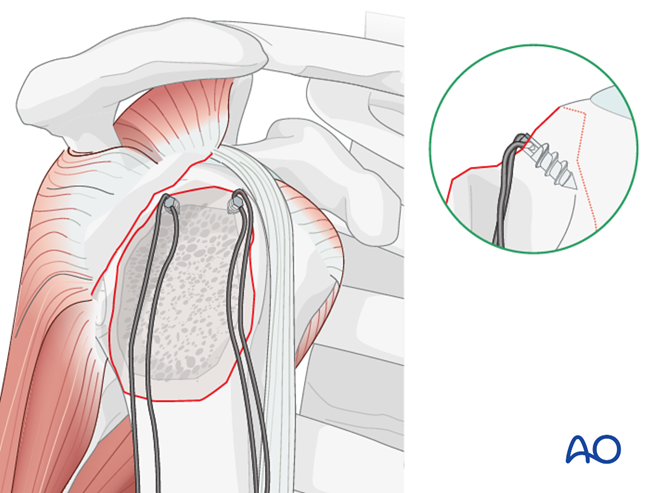 ORIF - Screw or suture fixation for Extraarticular 2-part, greater ...