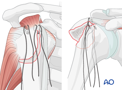 ORIF - Screw or suture fixation for Extraarticular 2-part, greater ...