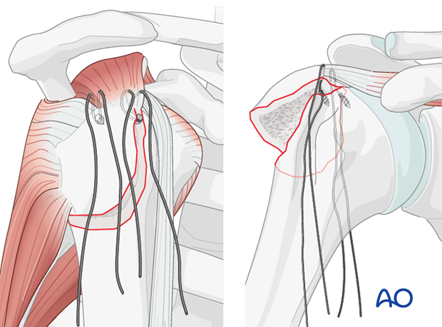 11_O40_i510 Passing the sutures through the supraspinatus tendon