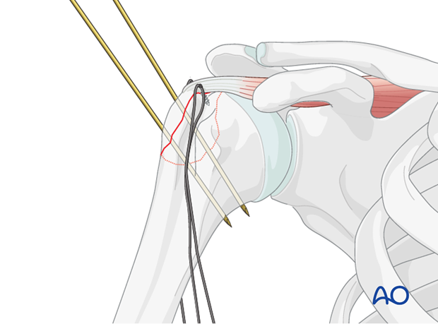 11_O40_i520 Reduction and preliminary fixation of greater tuberosity