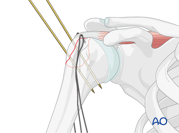 Reduction and preliminary fixation of greater tuberosity 