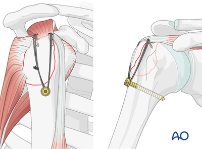 Orif - Screw Or Suture Fixation For Extraarticular 2-part, Greater 