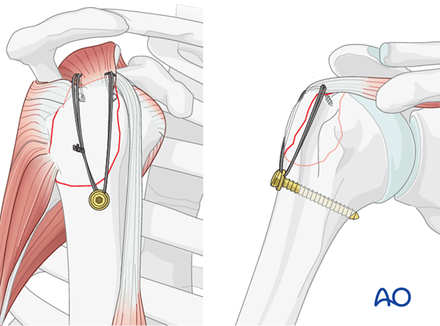 11_O40_i530 Distal fixation of suture through washer