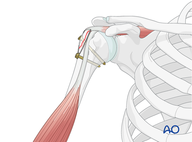 Tension band suturing combined with lag screw fixation