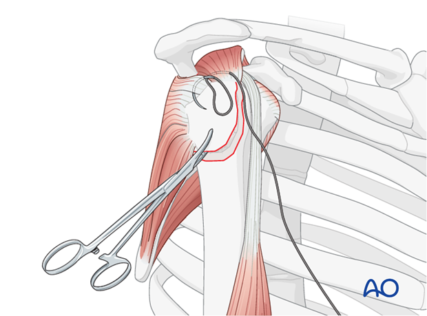 Insert stay sutures through the supraspinatus, and if necessary, the infraspinatus tendon. 