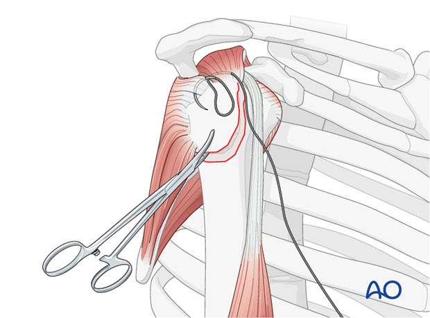 11_O40_Intraosseous_suture_i225 Insert stay sutures through the supraspinatus, and if necessary, the infraspinatus tendon.