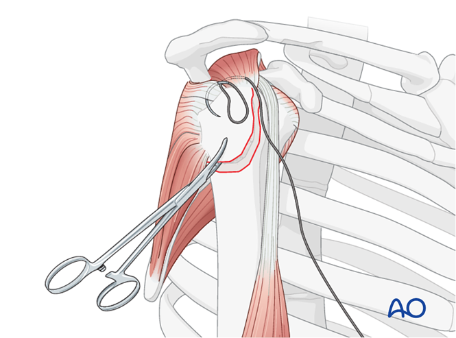 ORIF - Screw or suture fixation for Extraarticular 2-part, greater ...