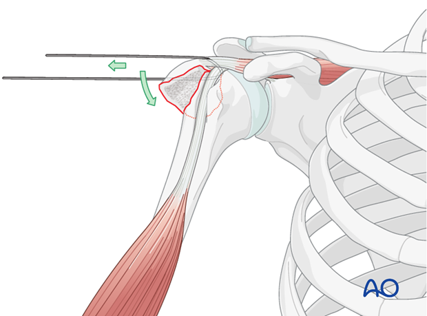 11_O40_Intraosseous_suture_i230 Reduce the greater tuberosity properly by pulling on the stay suture(s).
