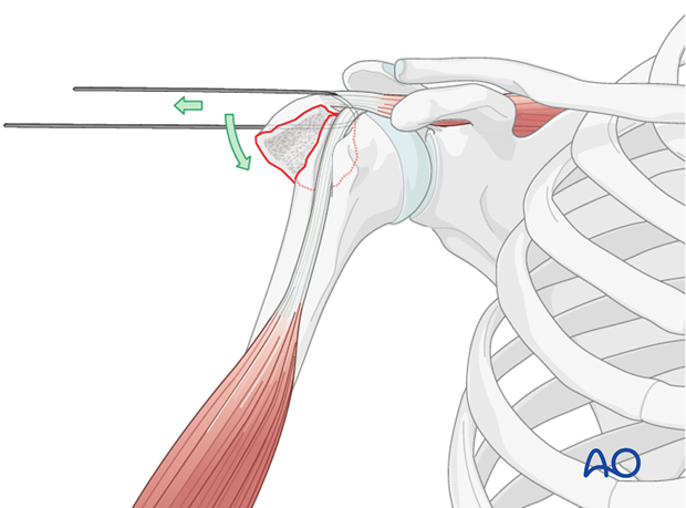 Reduce the greater tuberosity properly by pulling on the stay suture(s).