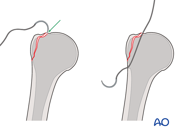 11_O40_Intraosseous_suture_i260 Alternative: suture deep to the fragment and over it
