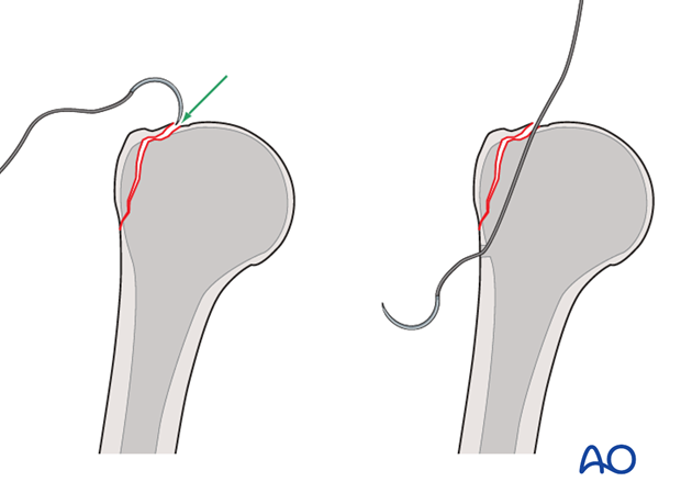 Alternative: suture deep to the fragment and over it