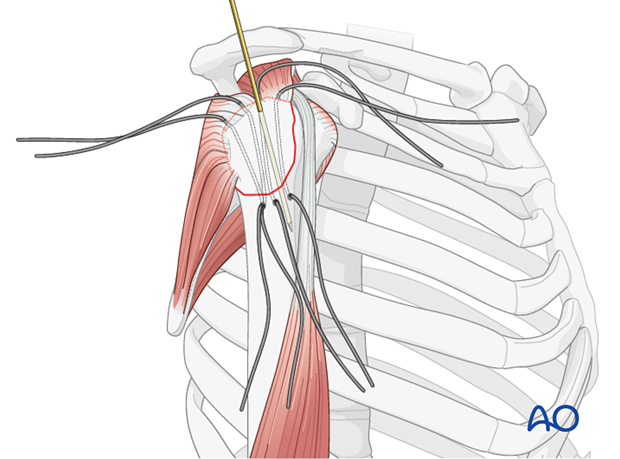 11_O40_Intraosseous_suture_i261 Stabilization with K wires