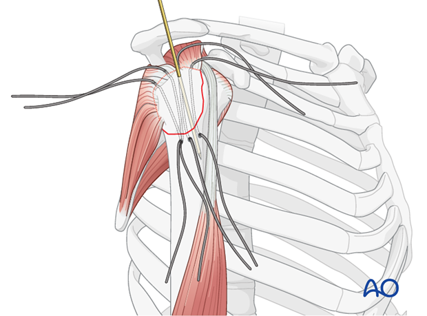 Stabilization with K wires