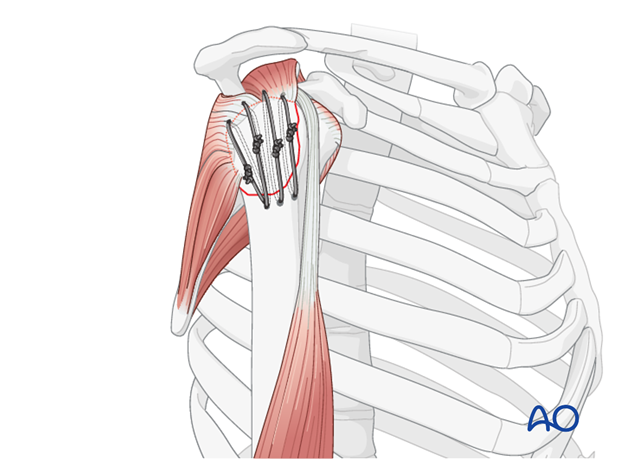 11_O40_Intraosseous_suture_i270 Fixation of fracture with individual sutures