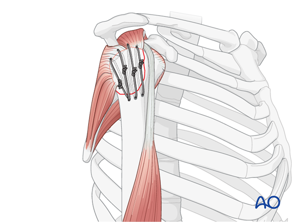 Fixation of fracture with individual sutures