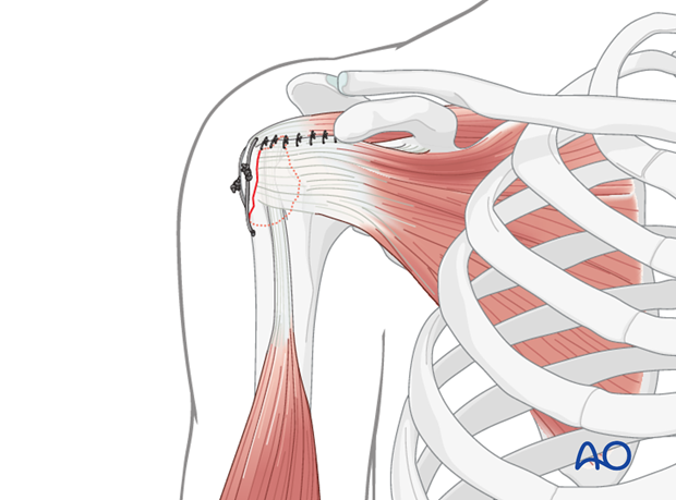 11_O40_Intraosseous_suture_i310 Sutures to close rotator cuff interval