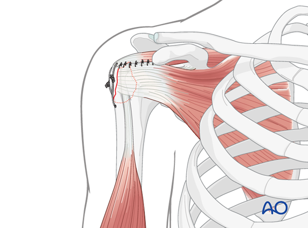 ORIF - Screw or suture fixation for Extraarticular 2-part, greater ...