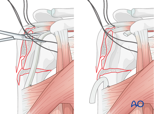 Temporarily attach the bicipital tendon to the superior border of the major pectoralis.