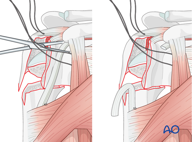 Temporarily attach the bicipital tendon to the superior border of the major pectoralis.