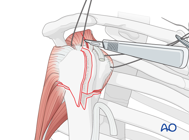 The rotator cable extends from lesser tubercle of humerus to greater