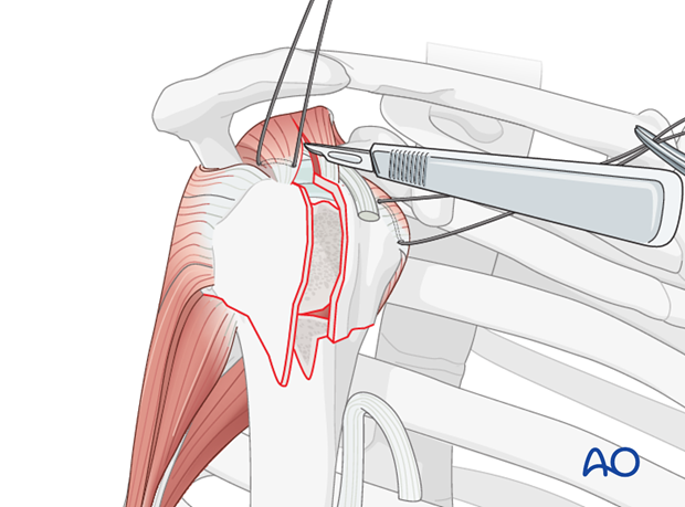 Divide the soft tissues over the fracture, and extend this incision along supraspinatus muscle fibers as shown. 