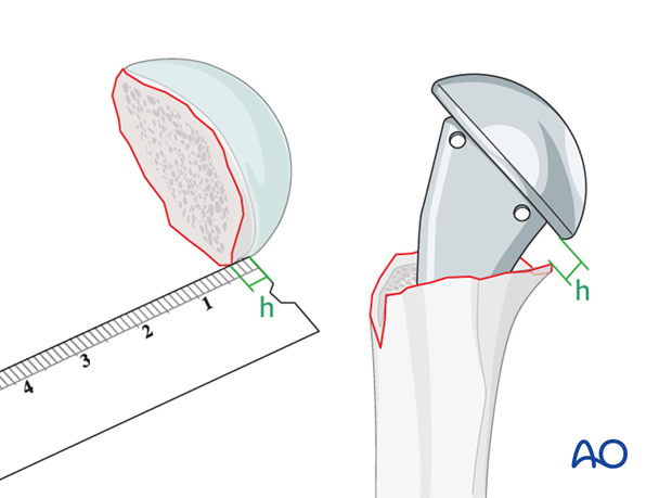 The posteromedial metaphyseal extension (h) determines the implantation height of the prosthesis.