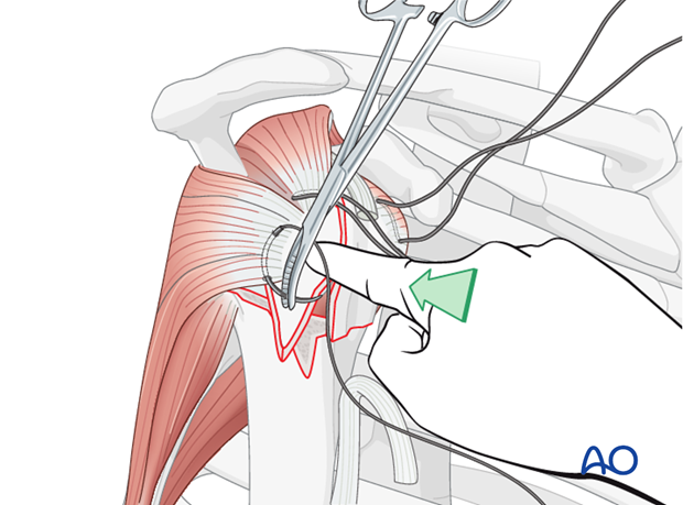 Insert a suture into the infraspinatus tendon. 