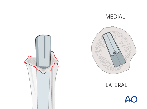 Pearl: Prosthesis with pronounced calcar design