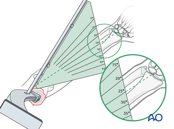 Hemiarthroplasty for 4-Part, marked displacement, fragmentary articular ...