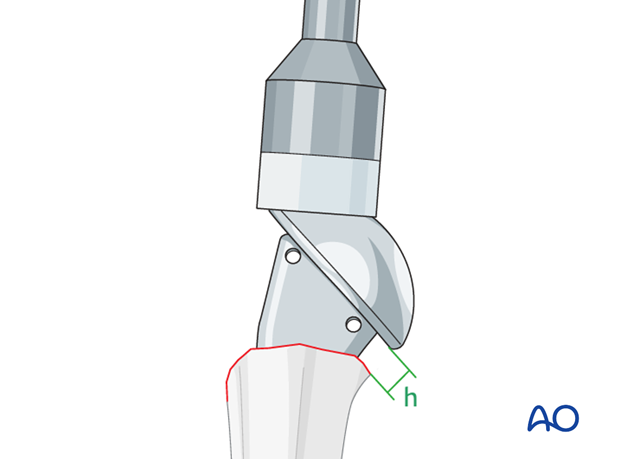 Insert the prosthesis, respecting the proper insertion height, and the retroversion. 