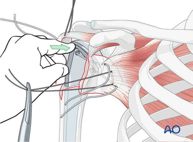 The rotator cable extends from lesser tubercle of humerus to greater