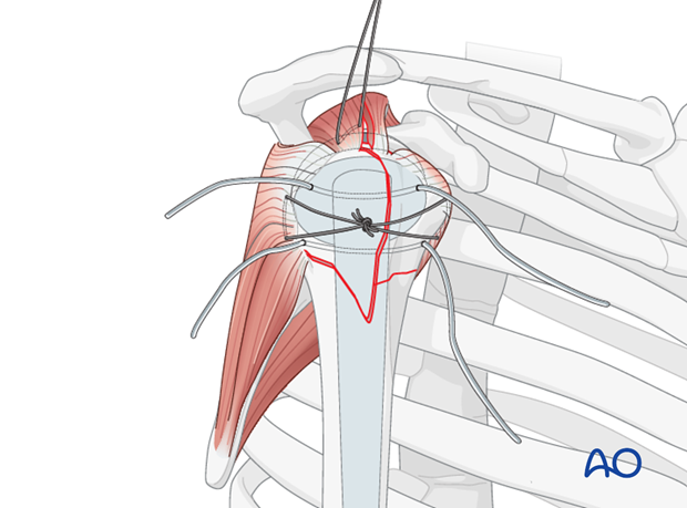 The rotator cable extends from lesser tubercle of humerus to greater